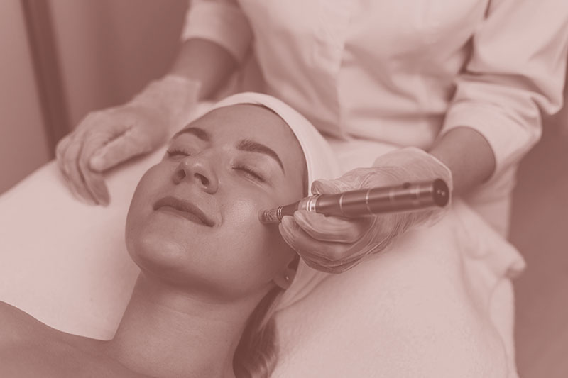 Microneedling-London