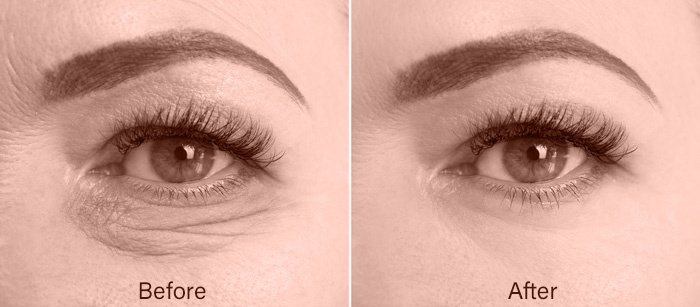 Best-Lumi-Eyes-treatment-Purley