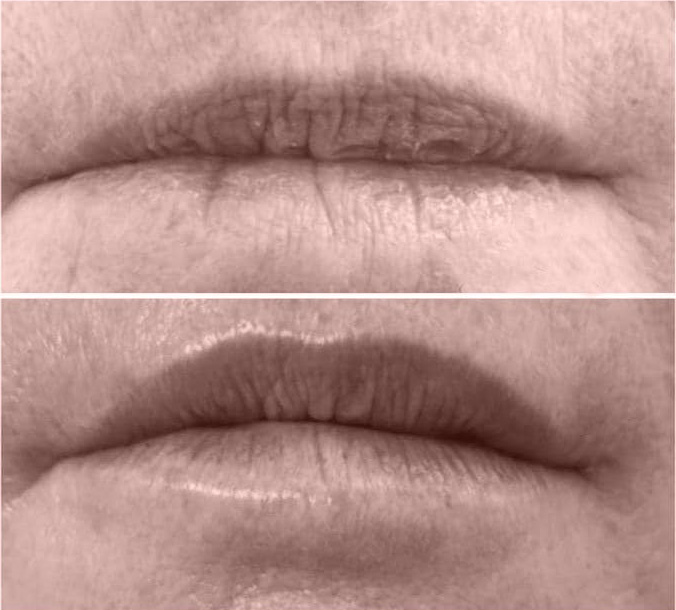 Lip-Fillers-Before-and-After