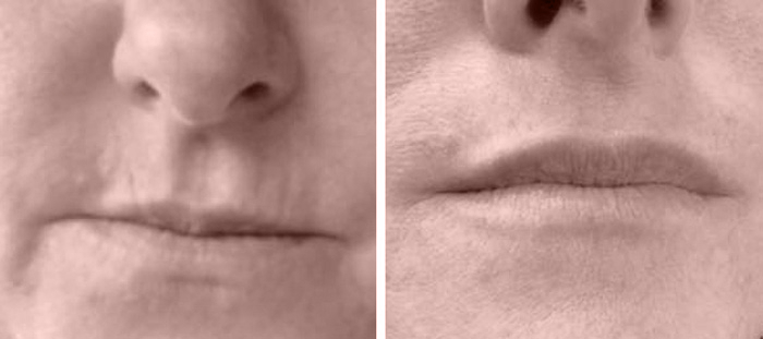 Lip-Fillers-Before-and-after-filler