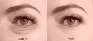 Lumi-Eyes-treatment-Putney